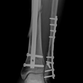 Osteosynthese eines Unterschenkelschaftbruches (Unterschenkelschaftfraktur) li.