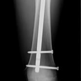 Osteosynthese eines Oberschenkelschaftbruches li. mit Marknagel (Femurfraktur)