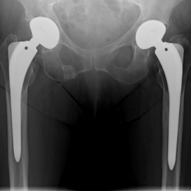 Hüfttotalendoprothese li.