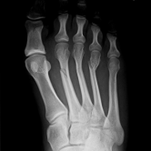Osteosynthese bei Mittelfußknochenbrüchen 2-4 (Metatarsale-2-4 Fraktur) re.