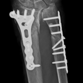 Osteosynthese eines Ellenbruches und eines Speichenbruches (Ulnafraktur und Radiusfraktur) re.