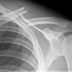 Osteosynthese eines Schlüsselbeinbruches (Claviculafraktur) li.
