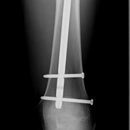 Osteosynthese eines Oberschenkelschaftbruches li. mit Marknagel (Femurfraktur)