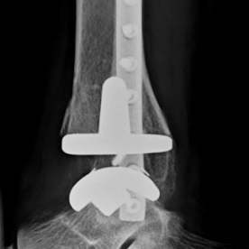 Obere Sprunggelenksprothese