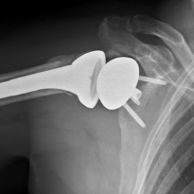 Schultertotalendoprothese li. (sogenannte inverse Prothese)