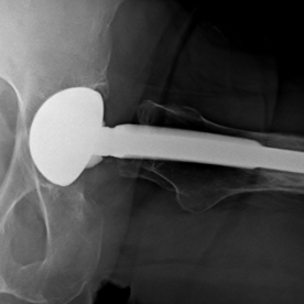 Hüfttotalendoprothese li.