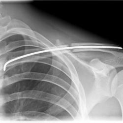 Osteosynthese eines Schlüsselbeinbruches (Claviculafraktur) li.