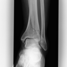 Bruch des körperfernen Schienbeins (Pilon tibiale-Fraktur) li.