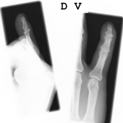 Knöcherner Strecksehnenausriss des Kleinfingers