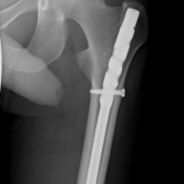 Osteosynthese eines Oberschenkelschaftbruches li. mit Marknagel (Femurfraktur)