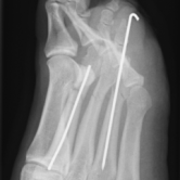 Osteosynthese bei Mittelfußknochenbrüchen 2-4 (Metatarsale-2-4 Fraktur) re.