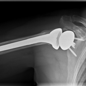 Schultertotalendoprothese li. (sogenannte inverse Prothese)