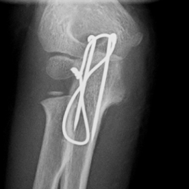 Osteosynthese eines Ellenhakenbruches (Olecranonfraktur) li.