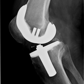 Knietotalendoprothese