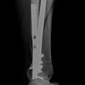 Osteosynthese eines Unterschenkelschaftbruches (Unterschenkelschaftfraktur) li.