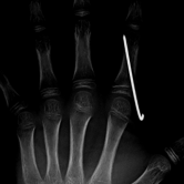 Osteosynthese der Fraktur und Fixierung mittels Draht