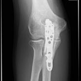 Osteosynthese eines Ellenhakenbruches (Olecranonfraktur) re.