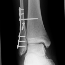 Osteosynthese eines Außenknöchelbruches (Fibulafraktur) mit Riss des Syndesmosenbandes li.