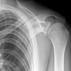 Osteosynthese eines Schlüsselbeinbruches (Claviculafraktur) li.