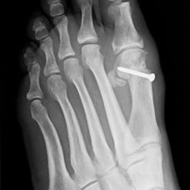 Korrigierende Umstellung des 1. Mittelfußknochens bei Hallux valgus li.