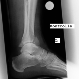 Bruch des körperfernen Schienbeins (Pilon tibiale-Fraktur) li.