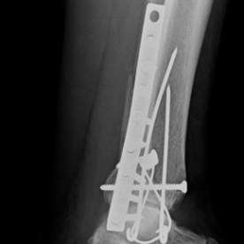Osteosynthese eines körperferner Innenknöchel- und Außenknöchelbruches (distale Tibia- und Fibulafraktur) re. oberes Sprunggelenk (OSG)
