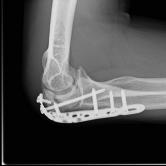 Osteosynthese eines Ellenhakenbruches (Olecranonfraktur) re.