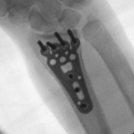 Osteosynthese eines körperfernen Speichenbruches (distale Radiusfraktur) li.