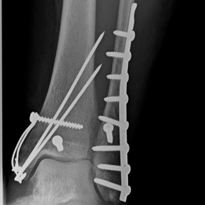 Osteosynthese eines körperferner Innenknöchel- und Außenknöchelbruches (distale Tibia- und Fibulafraktur) re. oberes Sprunggelenk (OSG)