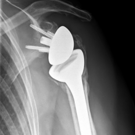 Schultertotalendoprothese li.